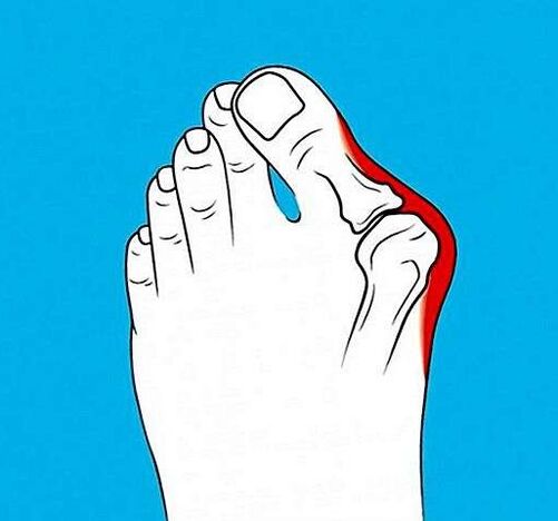 artroza e artikulacionit në gishtin e këmbës