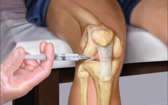 injeksion intra-artikular në nyje për artrozë