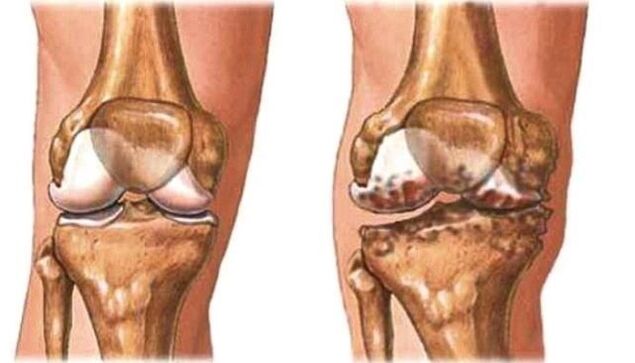 artrozë e shëndetshme e gjurit dhe gjurit