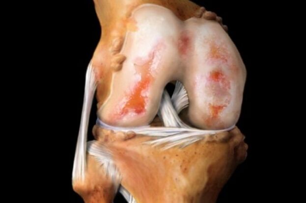 dëmtimi i kërcit në artrozën e gjurit