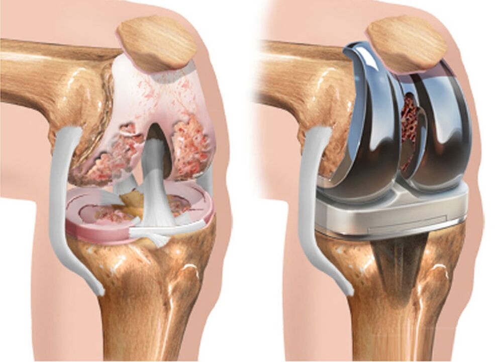 para dhe pas artrozës së nyjës së gjurit për artrozë