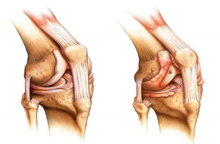 gjuri i shëndetshëm dhe artroza e kyçit të gjurit