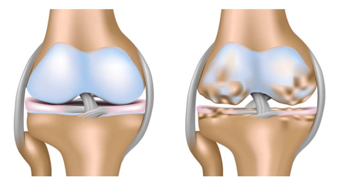 kërc i shëndetshëm dhe dëmtim i kyçit të gjurit me artrozë