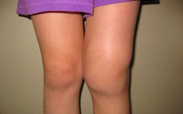 nyja e ënjtur e gjurit për shkak të osteoartritit