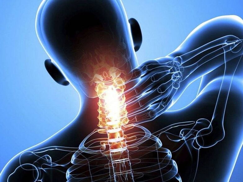 Osteokondroza e shpinës së qafës së mitrës shoqërohet me dhimbje në qafë