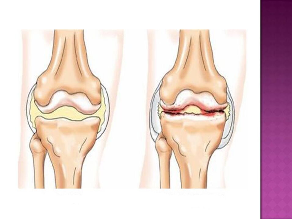 Artikulacioni është normal (majtas) dhe i prekur nga osteoartriti (djathtas)
