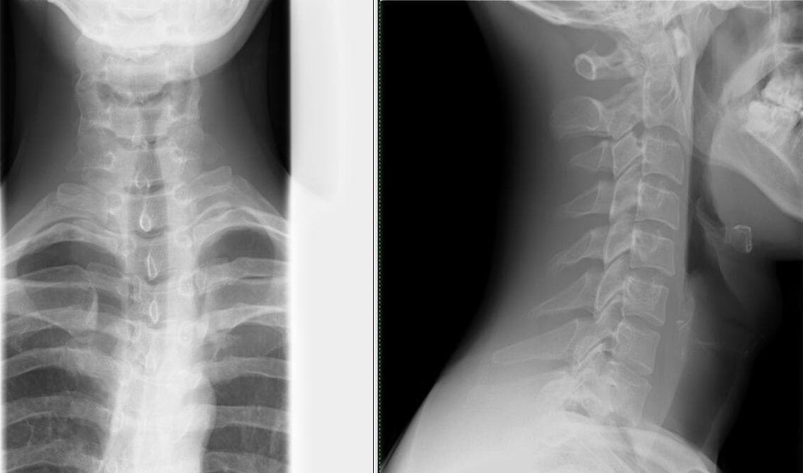 X-ray e shtyllës kurrizore është një metodë e thjeshtë dhe efektive për diagnostikimin e osteokondrozës