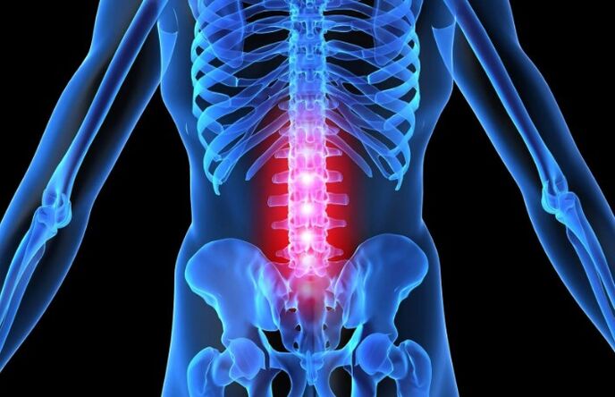 Osteokondroza e rajonit lumbar